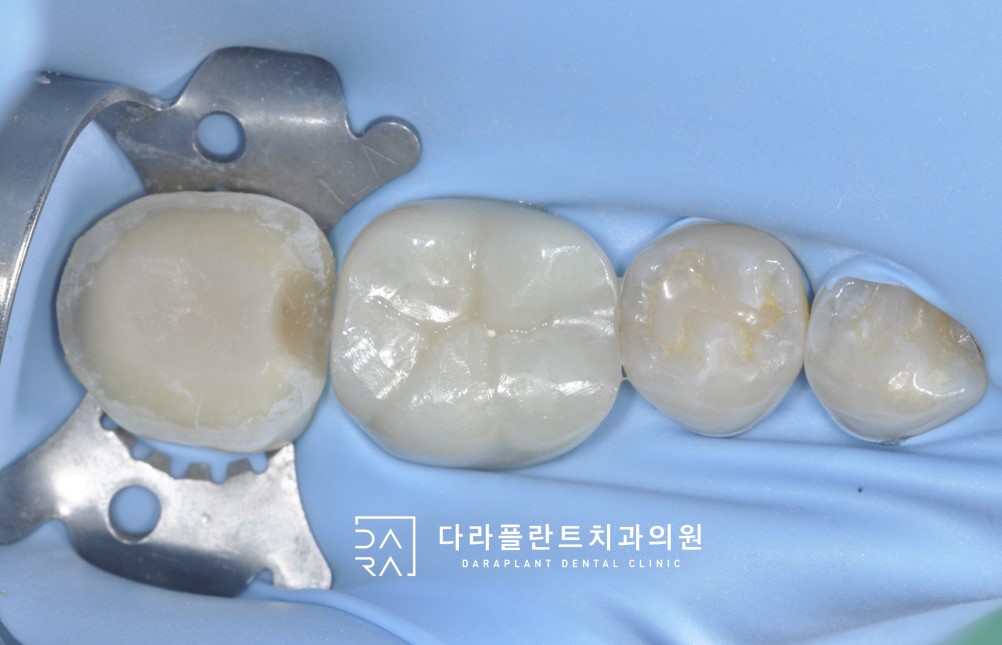 잇몸고름주머니가 생긴 치아를 신경치료 후 오버레이로 치료한 케이스