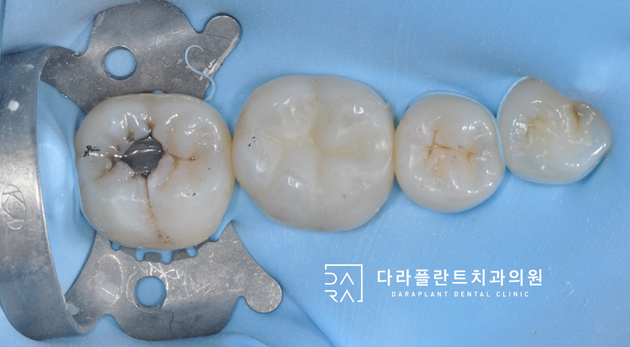오래된 아말감을 제거하고 레진빌드업으로 치료한 케이스