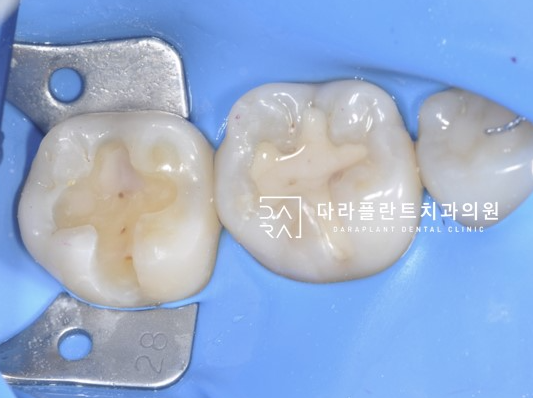 파절된 인레이를 레진빌드업으로 재치료한 케이스