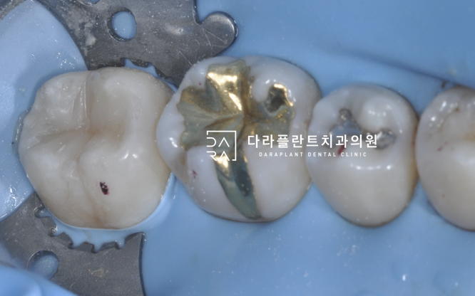 오래된 아말감을 레진빌드업으로 재치료한 케이스