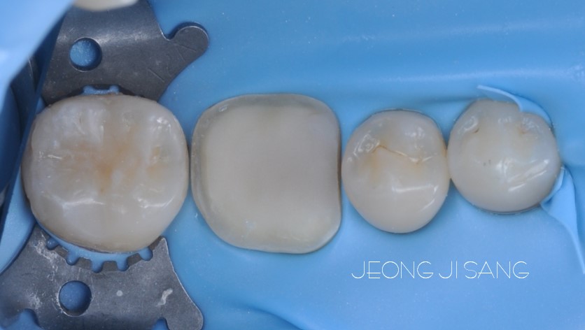깊은 충치를 제거하고 신경치료 후에 오버레이로 치료한 케이스