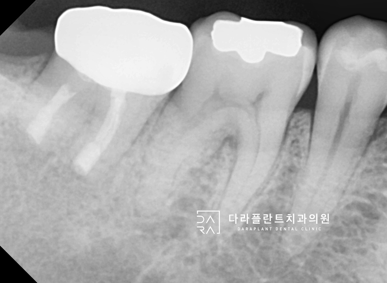 재신경치료 케이스 : 재신경치료가 불가한 경우