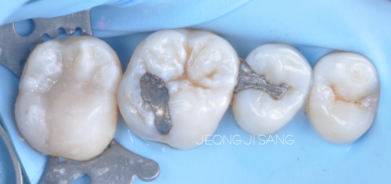 아말감을 제거하고 레진빌드업으로 치료한 케이스