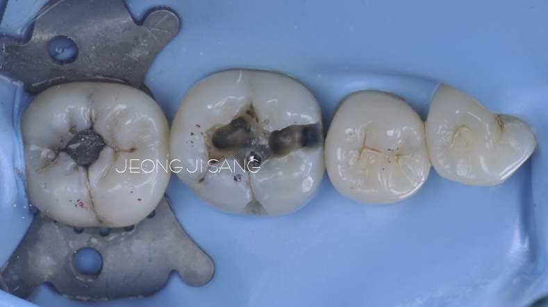 아말감을 제거하고 레진빌드업으로 치료한 케이스