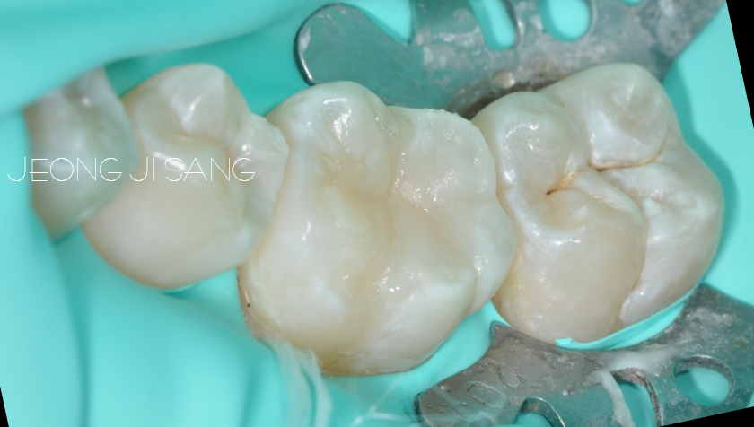 기존에 치료받은 재료가 탈락하여 레진빌드업으로 재치료한 케이스