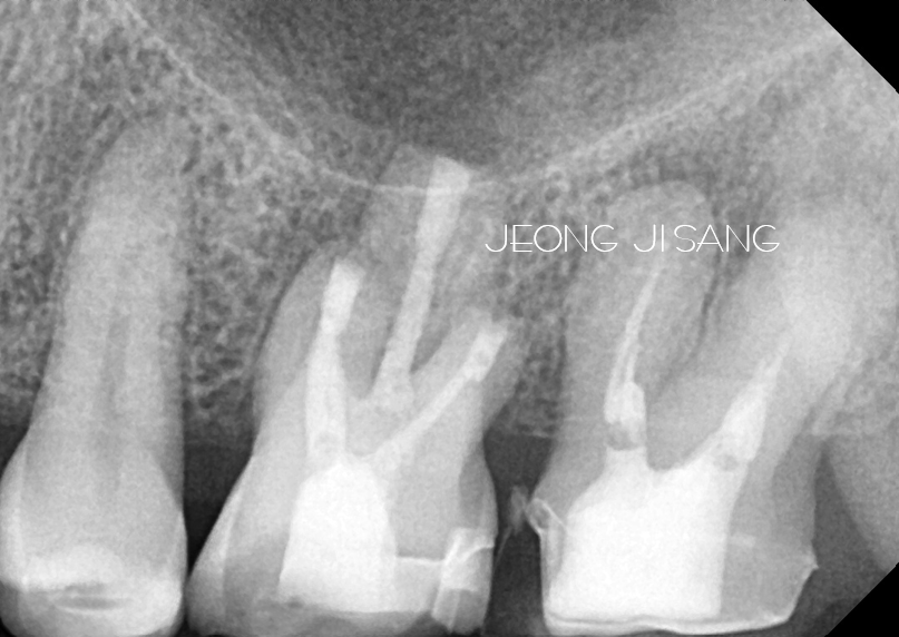 신경치료 후 통증이 개선되지 않는 경우, 발치 전에 해볼 수 있는 치아재식술