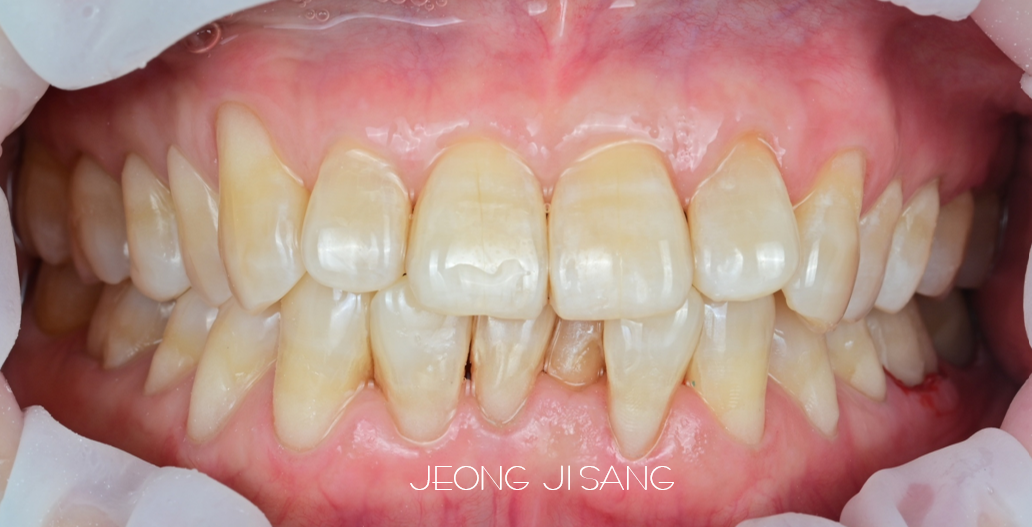 치아 잇몸부위 패임을 본드필로 치료한 케이스